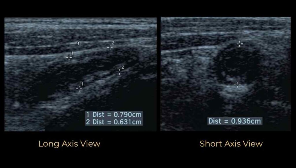 measurement of appendix