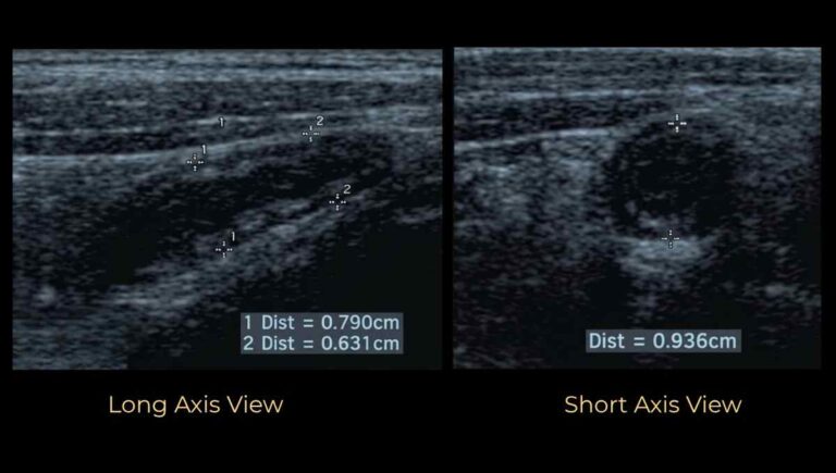 Appendicitis Ultrasound Protocol - Practical Sono