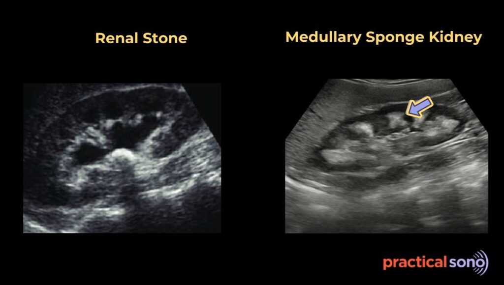 medullary sponge kidney ultrasound