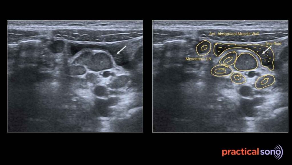 mesenteric adenitis ultrasound associated features