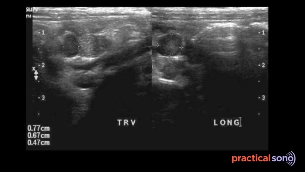 mesenteric adenitis ultrasound report example