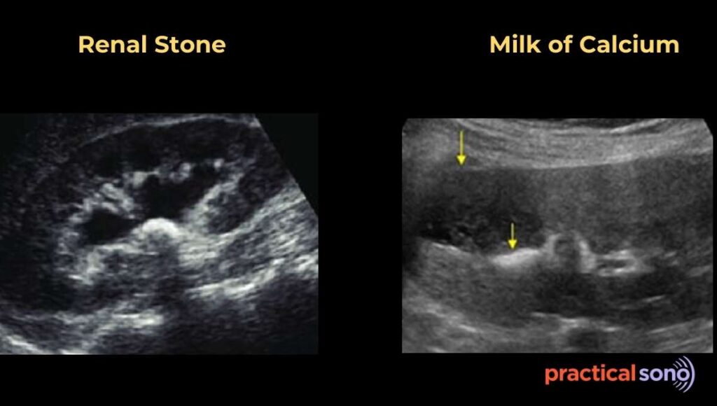 milk of calcium ultrasound