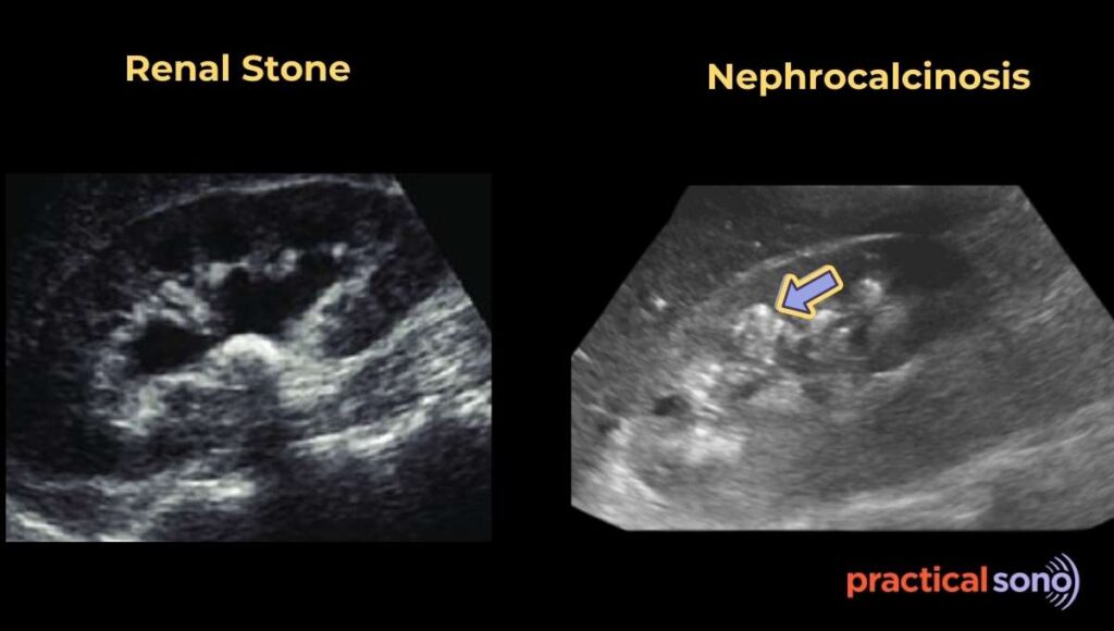 nephrocalcinosis ultrasound images