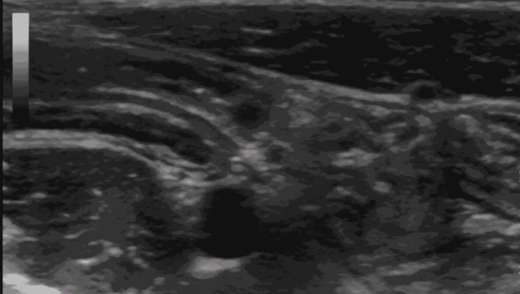 normal appendix ultrasound image 1