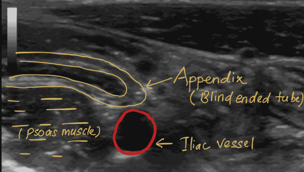 normal appendix ultrasound image 1 (labeled)