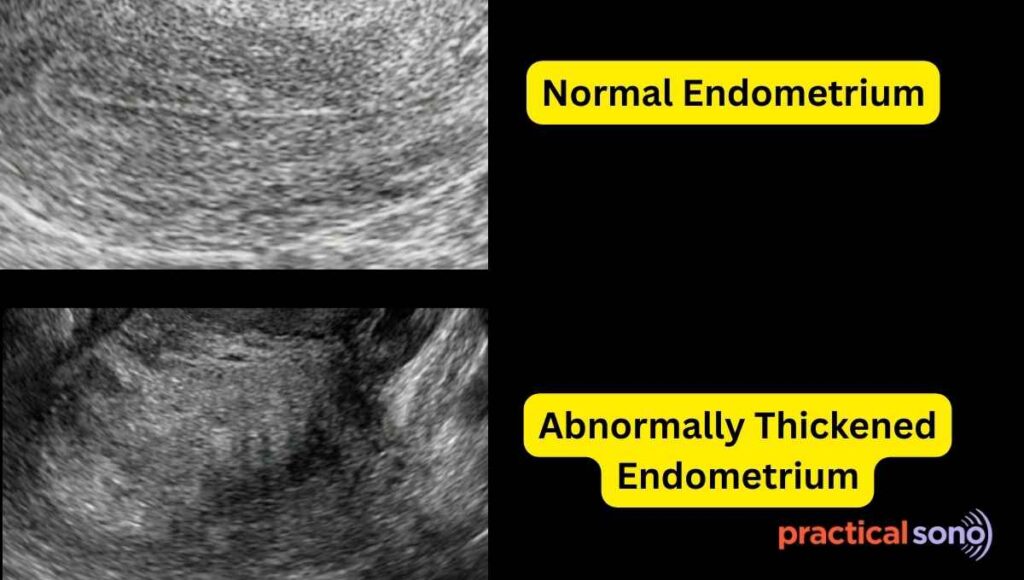 normal vs thickened endometrium comparison