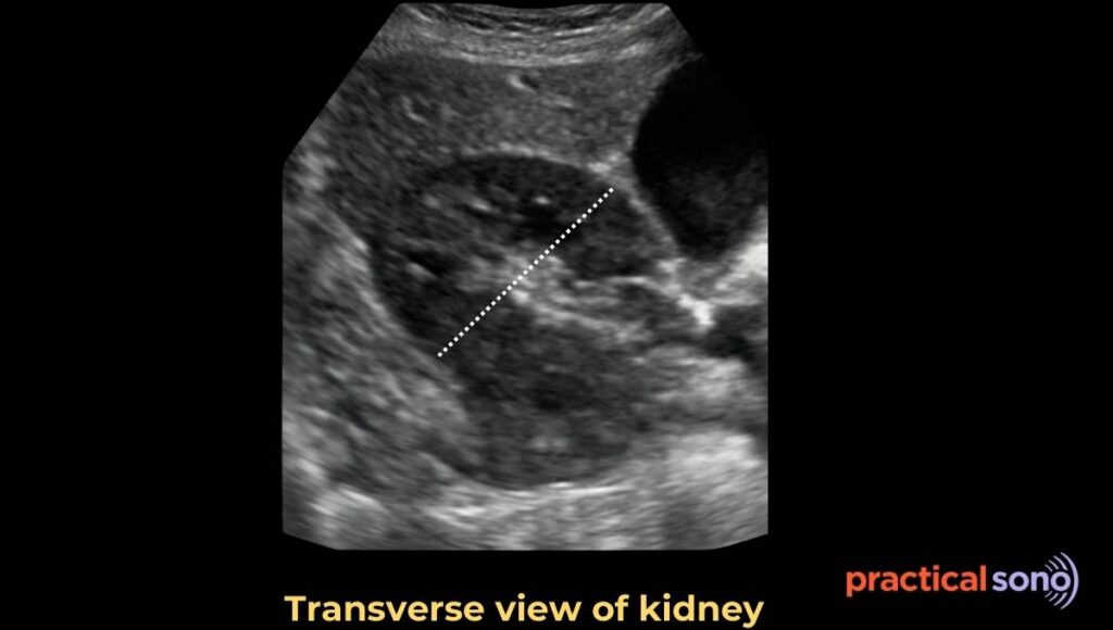 renal Anterior posterior diameter measurement in ultrasound