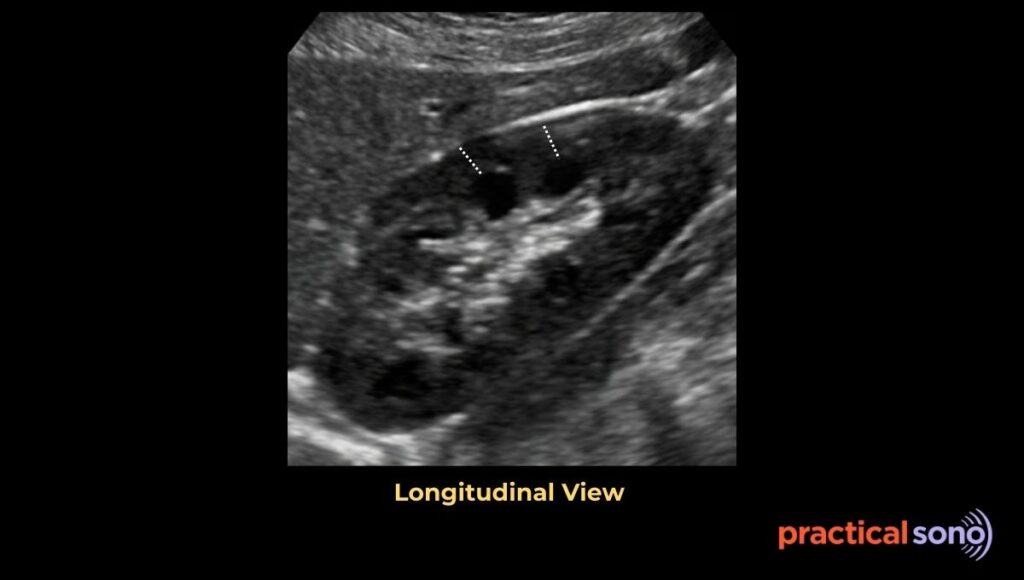 renal cortical thickness measurement in ultrasound
