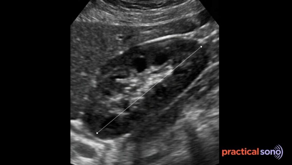 renal length measurement in ultrasound