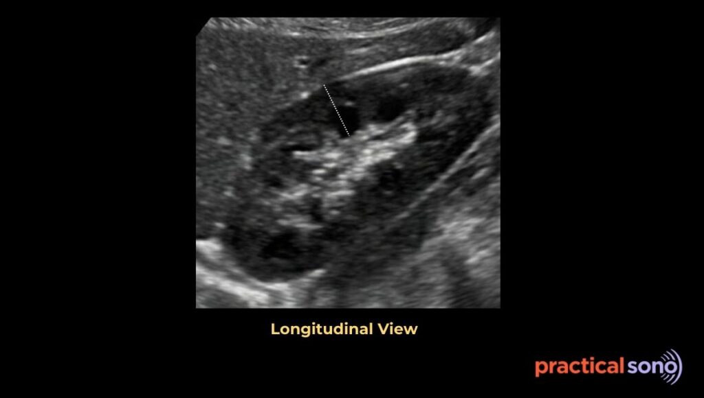 renal parenchymal thickness measurement in ultrasound