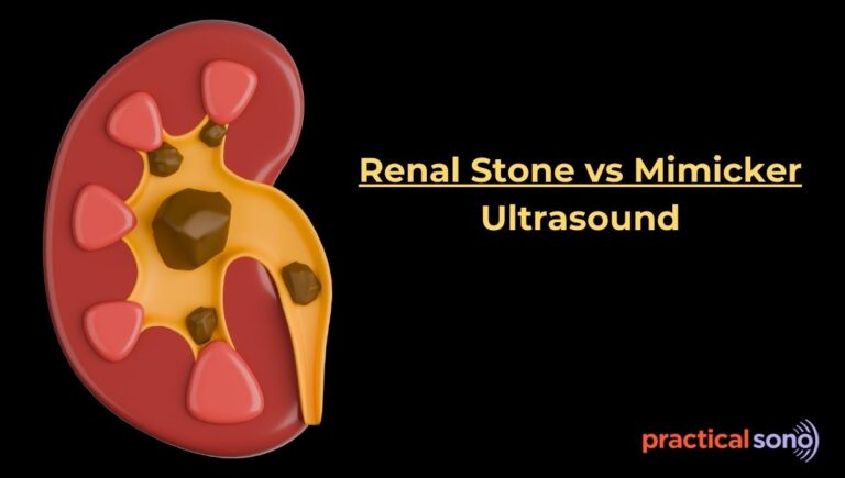 renal stone mimicker ultrasound featured image