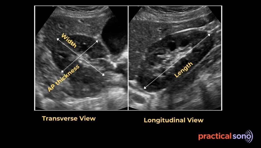 renal volume measurement in ultrasound