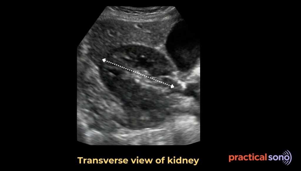 renal width measurement in ultrasound