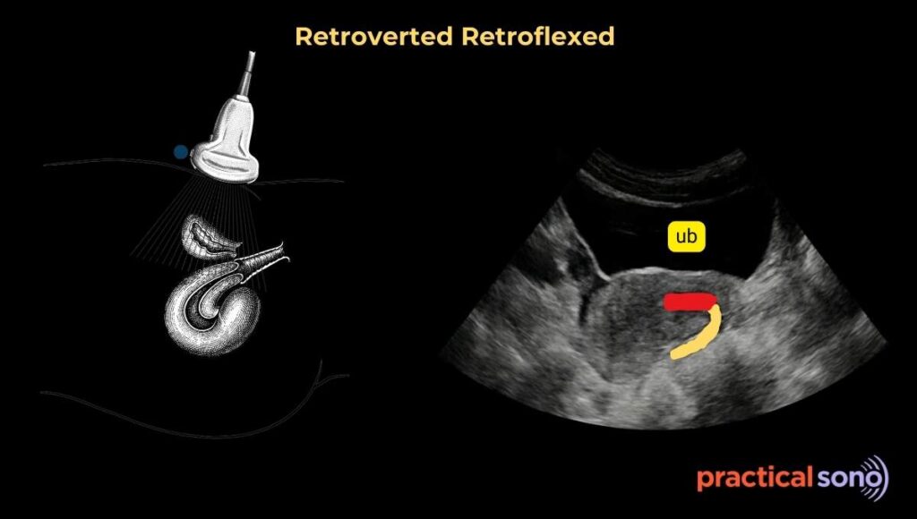 retroverted retroflexed uterus