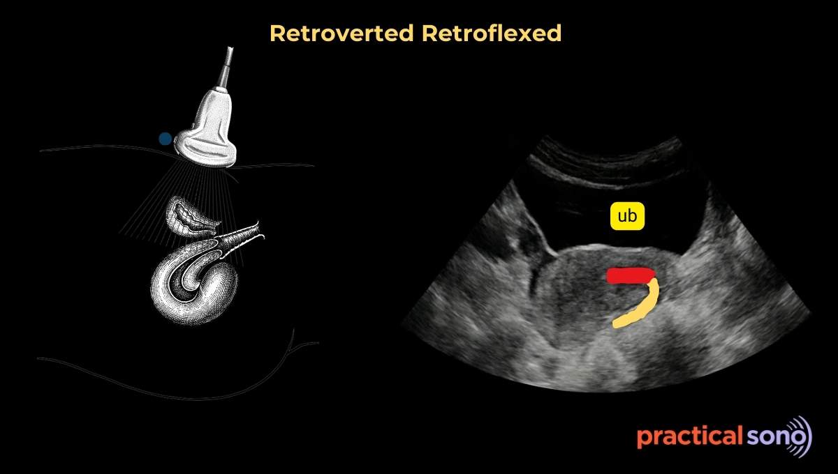 Positions of Uterus Ultrasound: How to Identify Them - Practical Sono