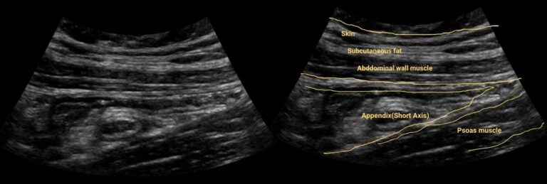 Appendicitis Ultrasound Protocol - Practical Sono