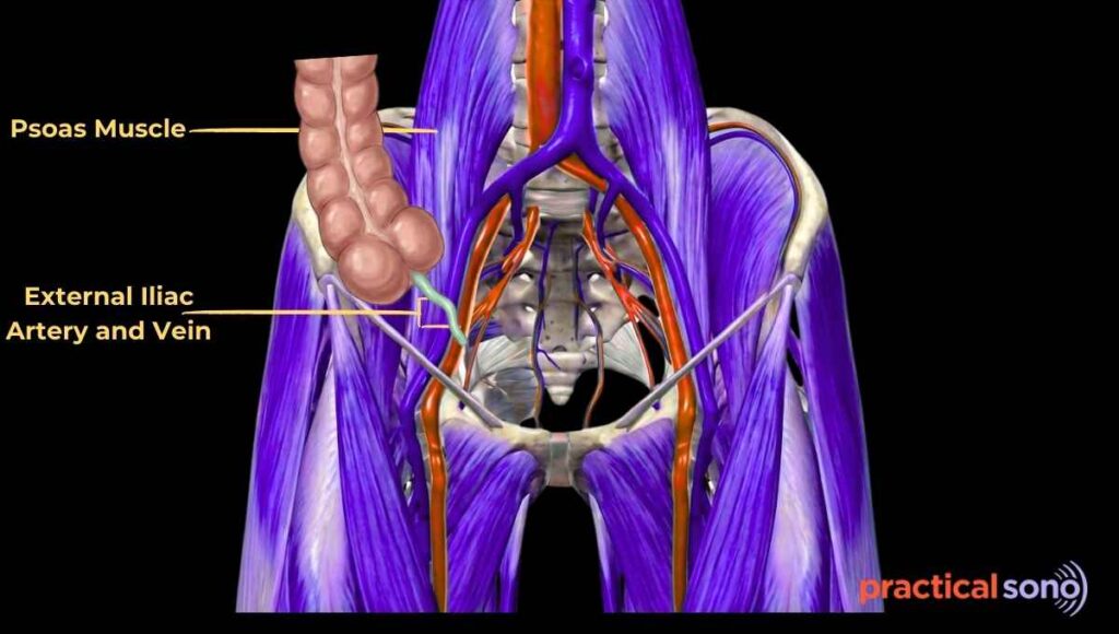 showing relationship of appendix with psoas muscle and external iliac vessel