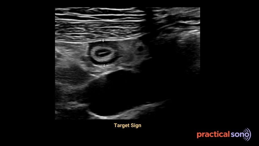 target sign appearance in ultrasound in appendicitis