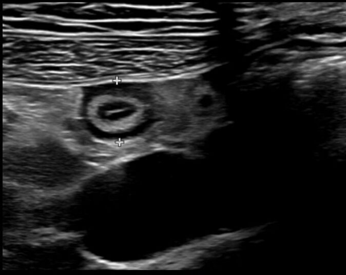 target sign appearance in ultrasound in appendicitis