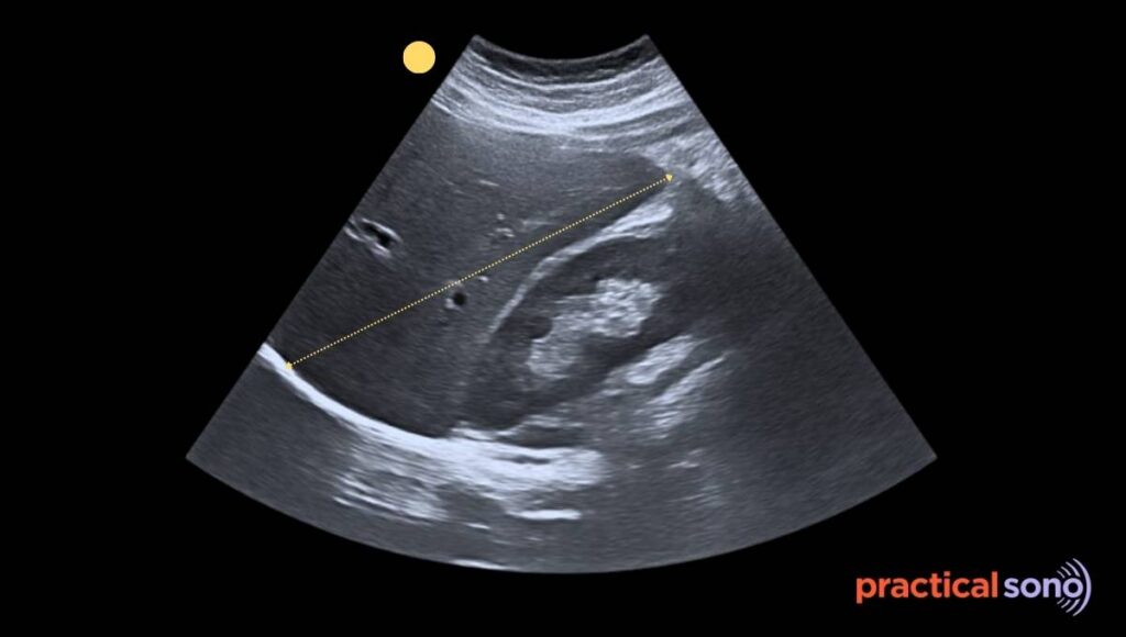 technique for caliper placement to measure liver size in ultrasound