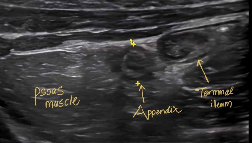 terminal ileum vs appendix How to differentiate on ultrasound