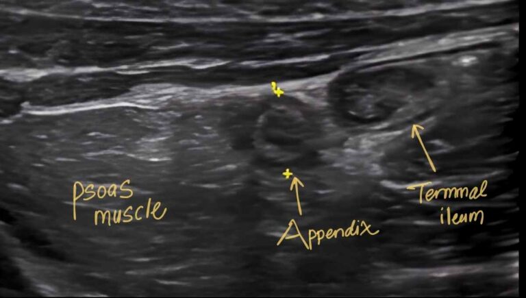 Appendicitis Ultrasound Protocol - Practical Sono