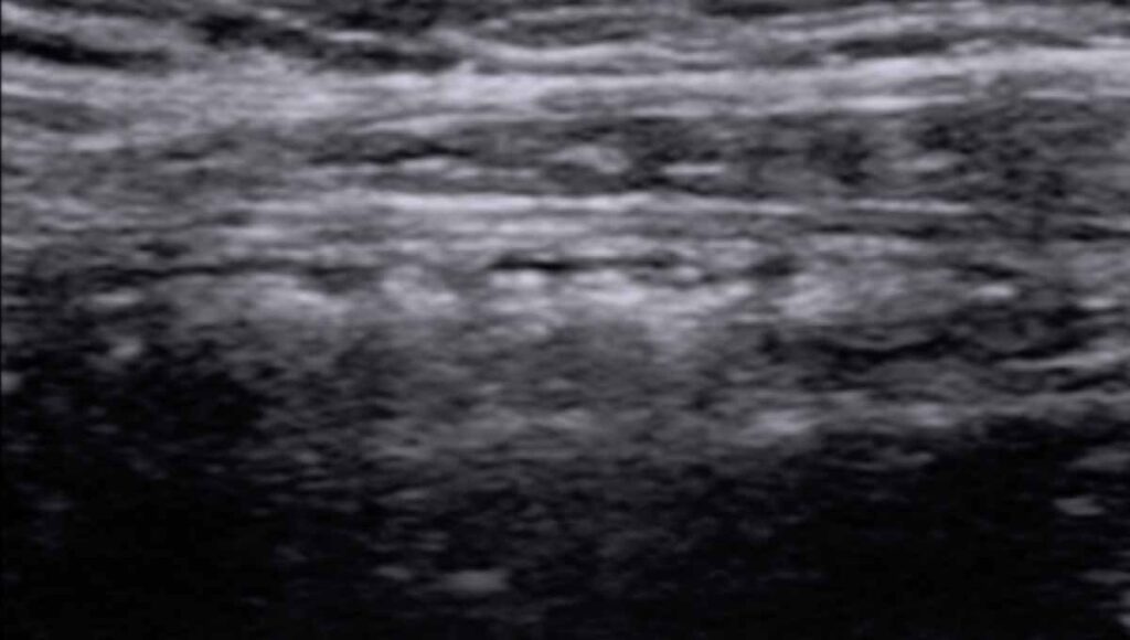 terminal ileum ultrasound