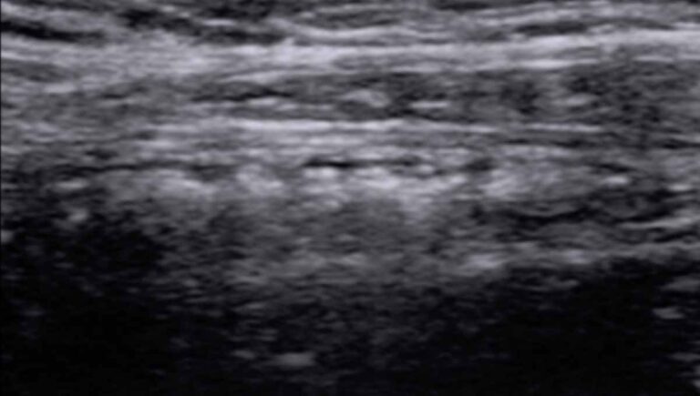 Appendicitis Ultrasound Protocol - Practical Sono