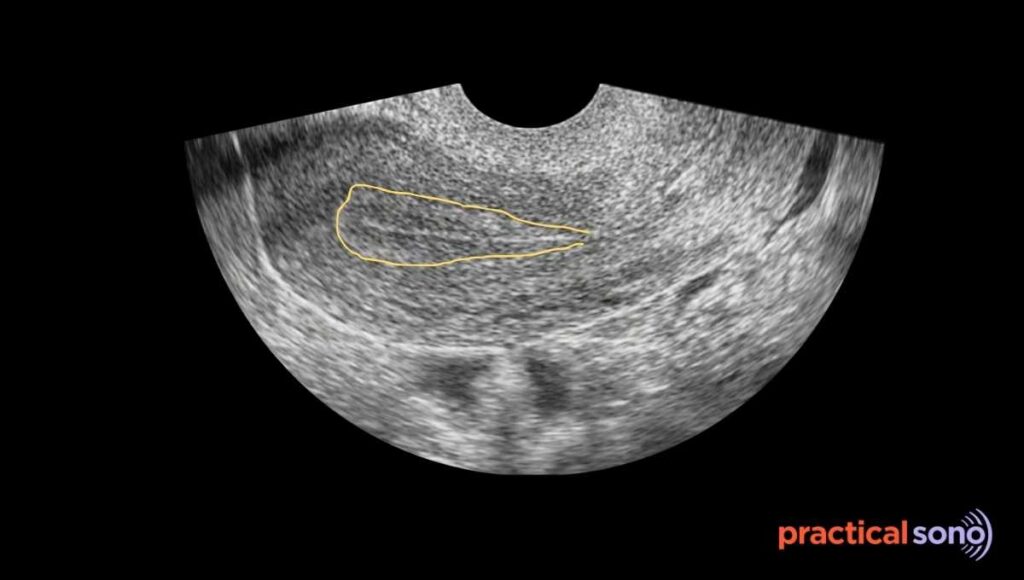 trilaminar apperance of endometrium transvaginal scan