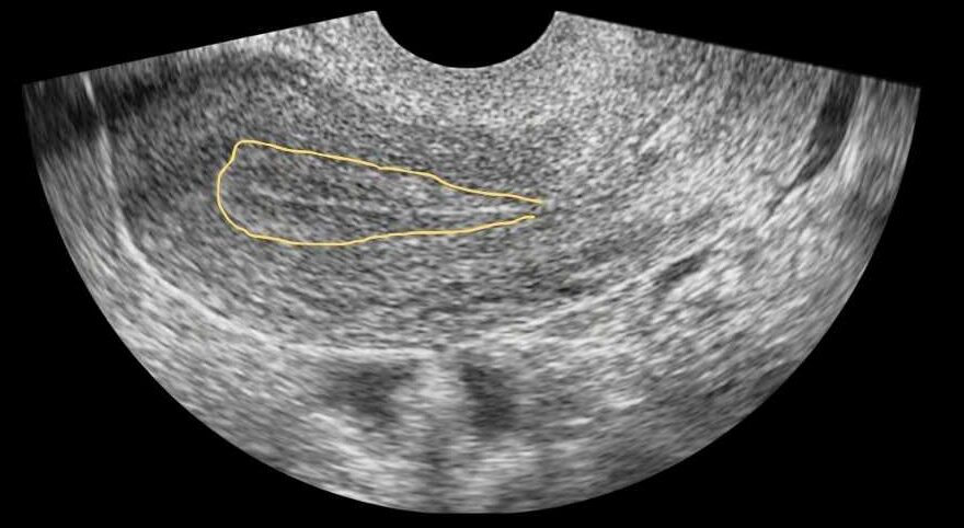 trilaminar apperance of endometrium transvaginal scan
