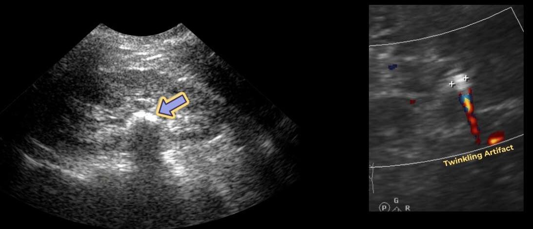 ultrasound features of renal stone