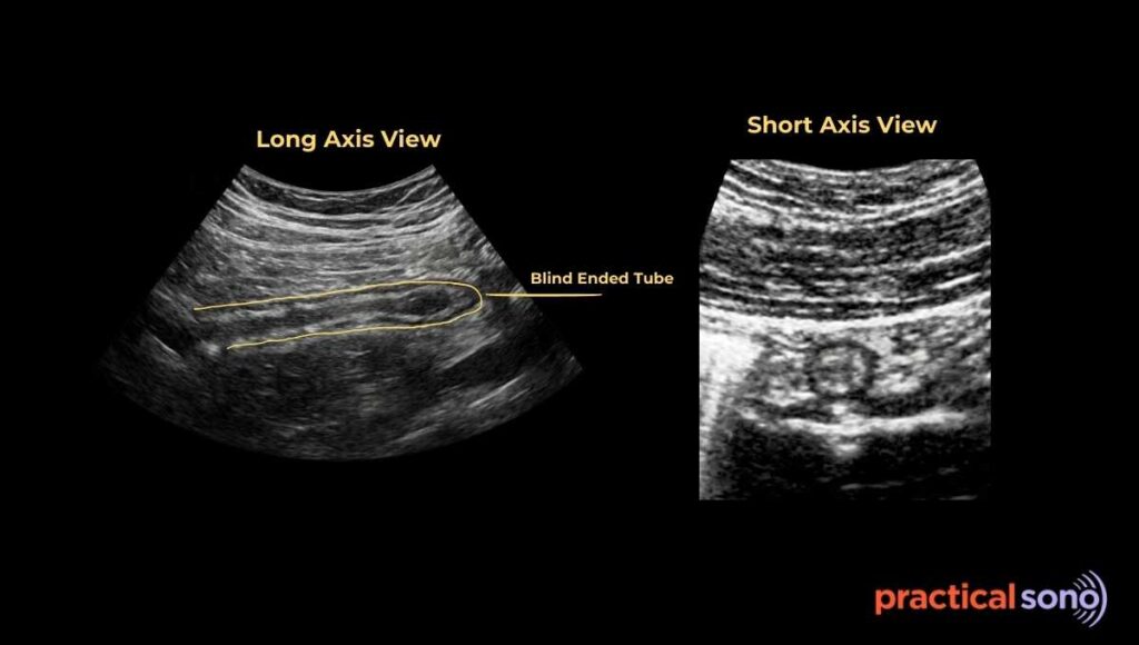 ultrasound image of normal appendix 