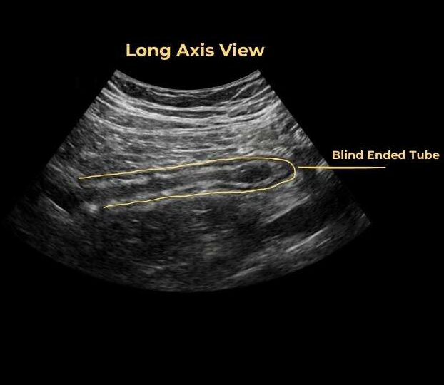 ultrasound image of normal appendix