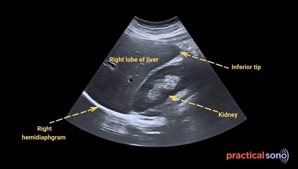 ultrasound landmark for measuring liver size