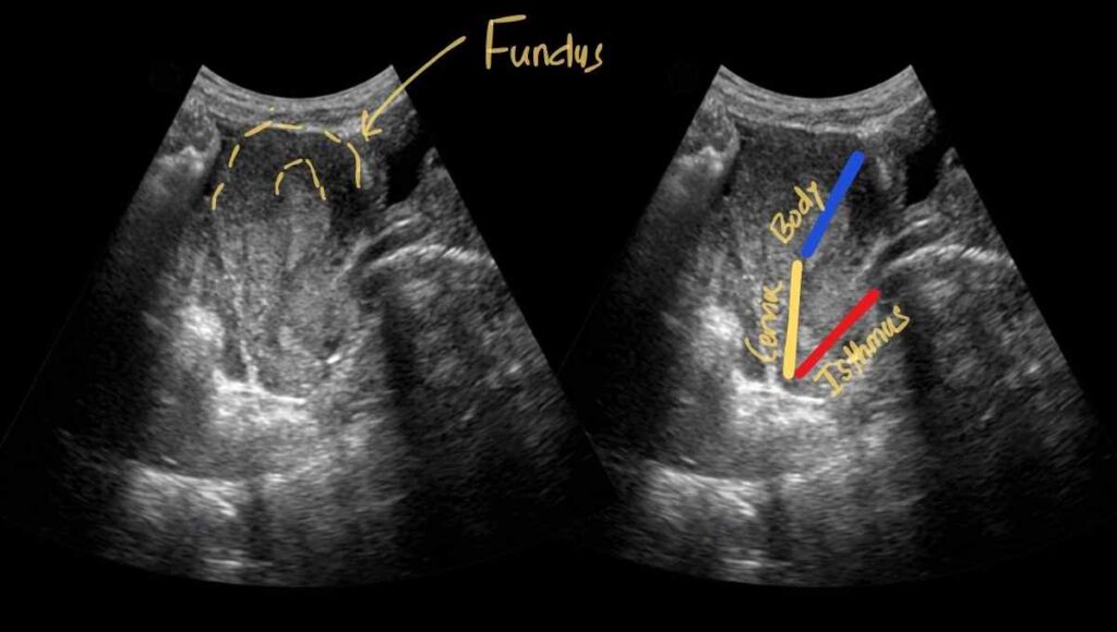 uterus longitudinal view showing its different parts fundus, body cervix, and isthmus