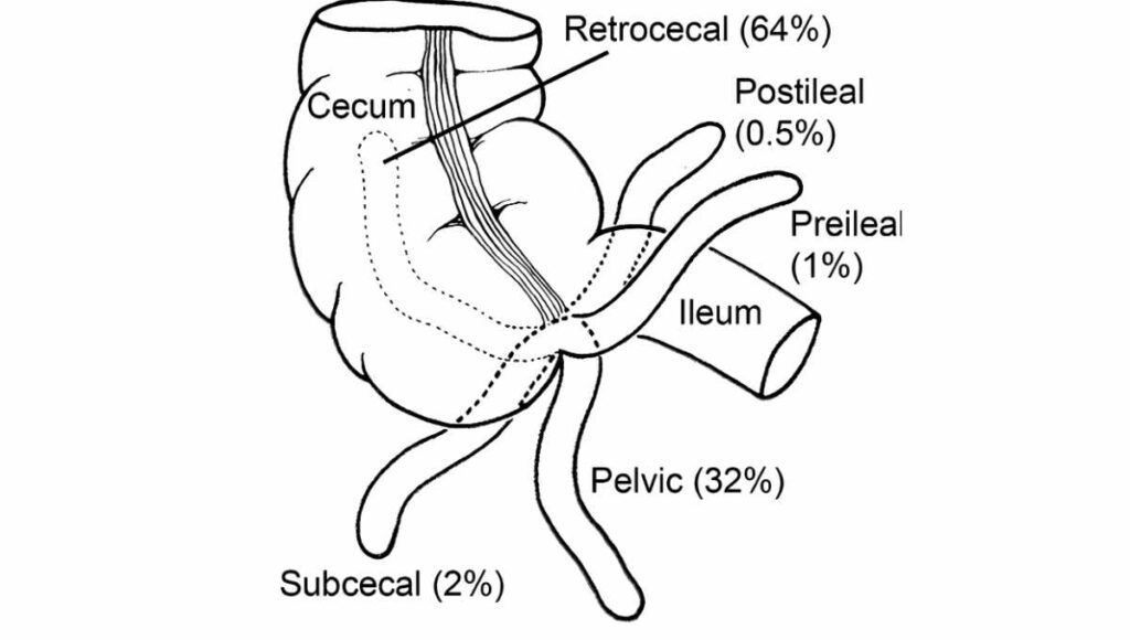 variation in position of appendix