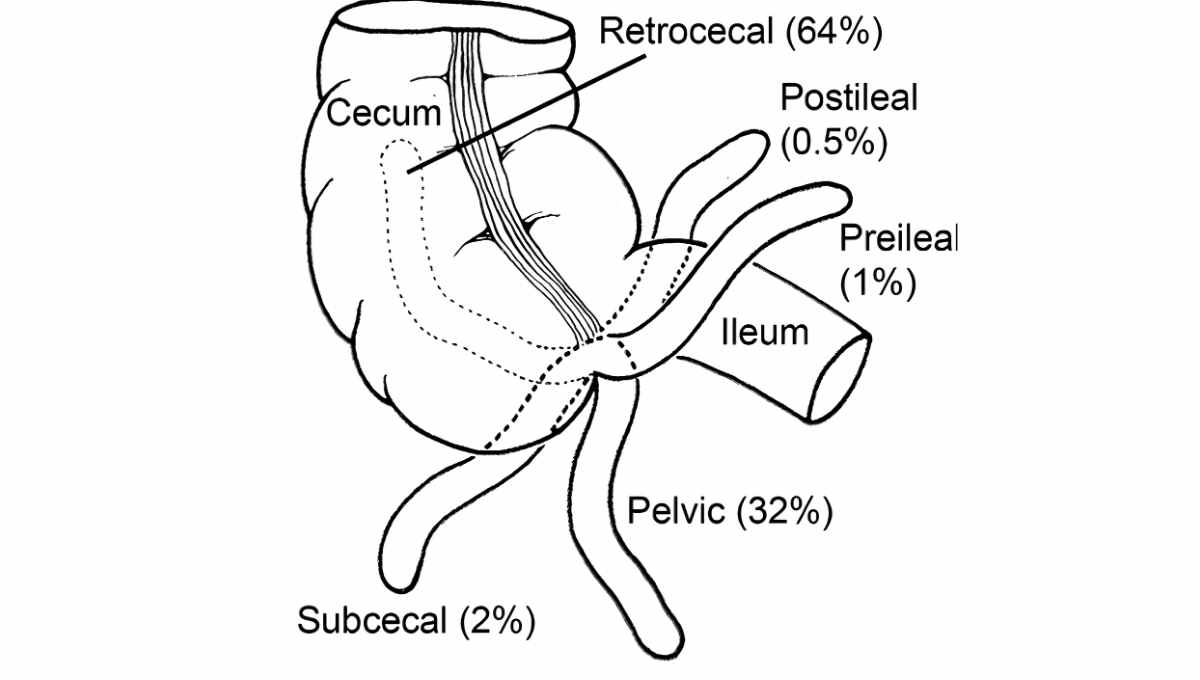Appendicitis Ultrasound Protocol - Practical Sono