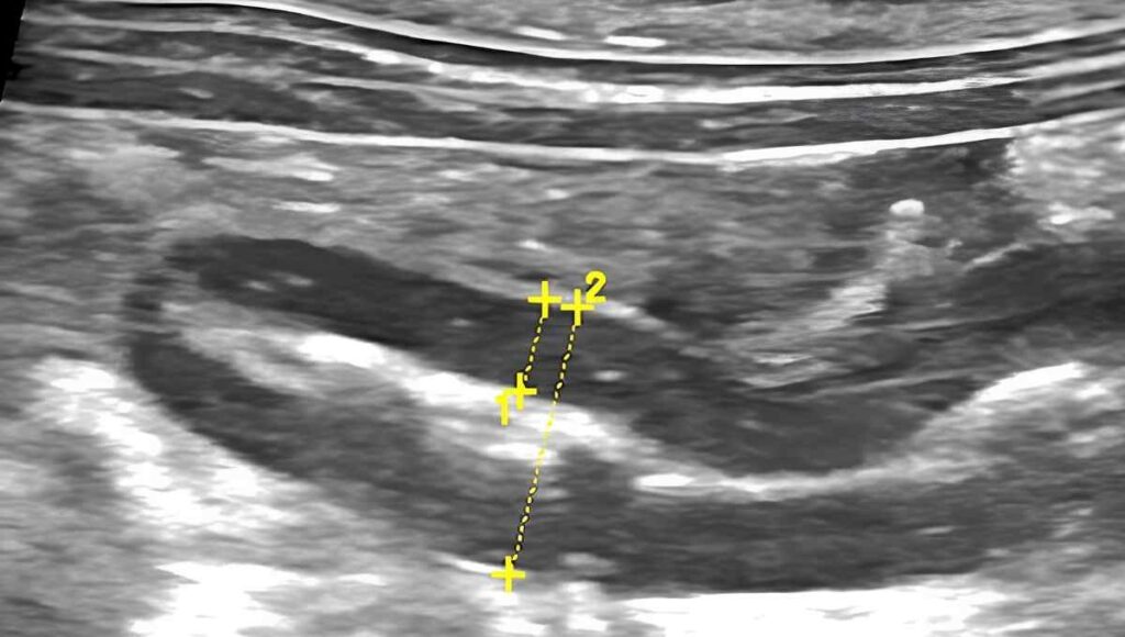 wall thickness measurement appendix