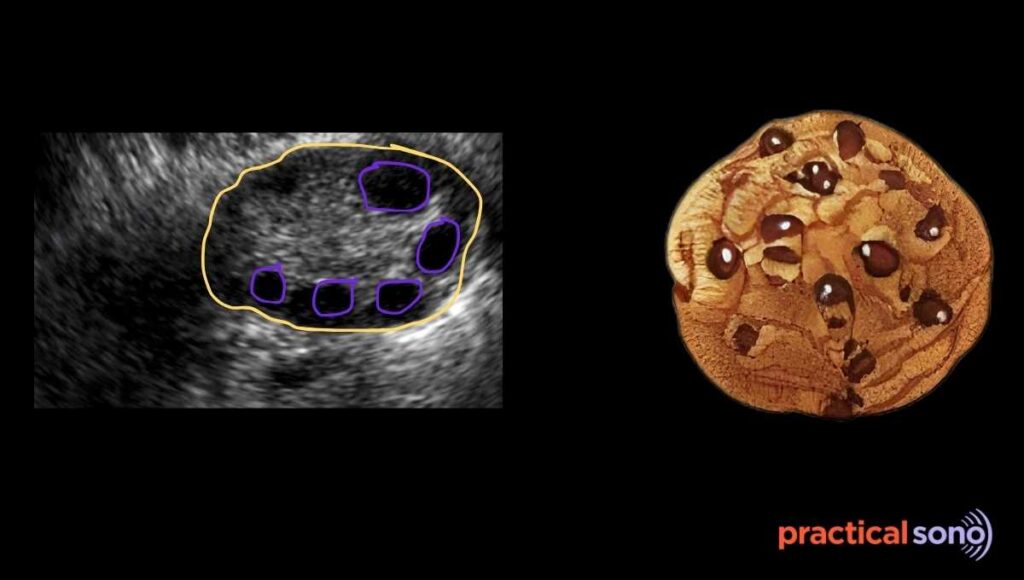 chocolate chips appearance of ovary