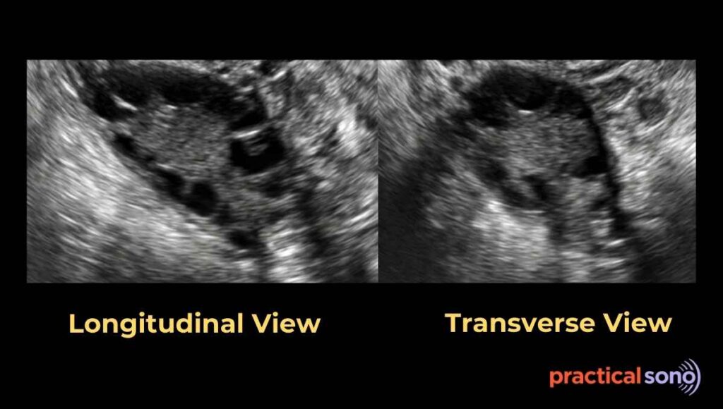 longitudinal and transverse view of ovary
