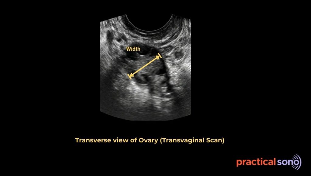 measurement of width of ovary in transverse view Transvaginal scan