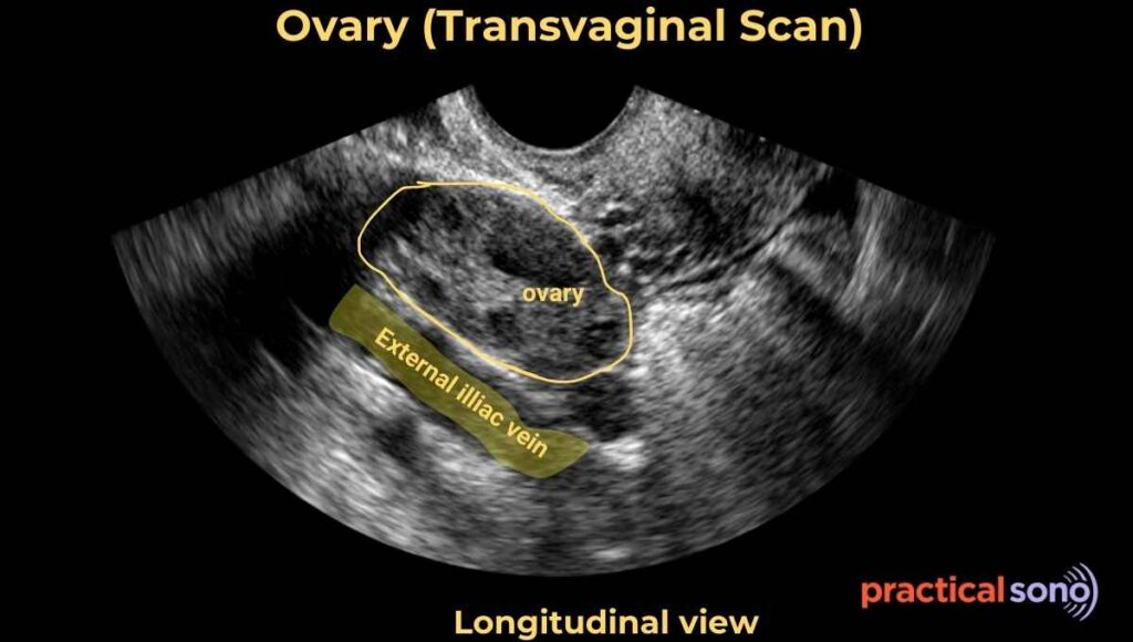 ovary transvaginal scan showing external iliac vein sonographic landmark