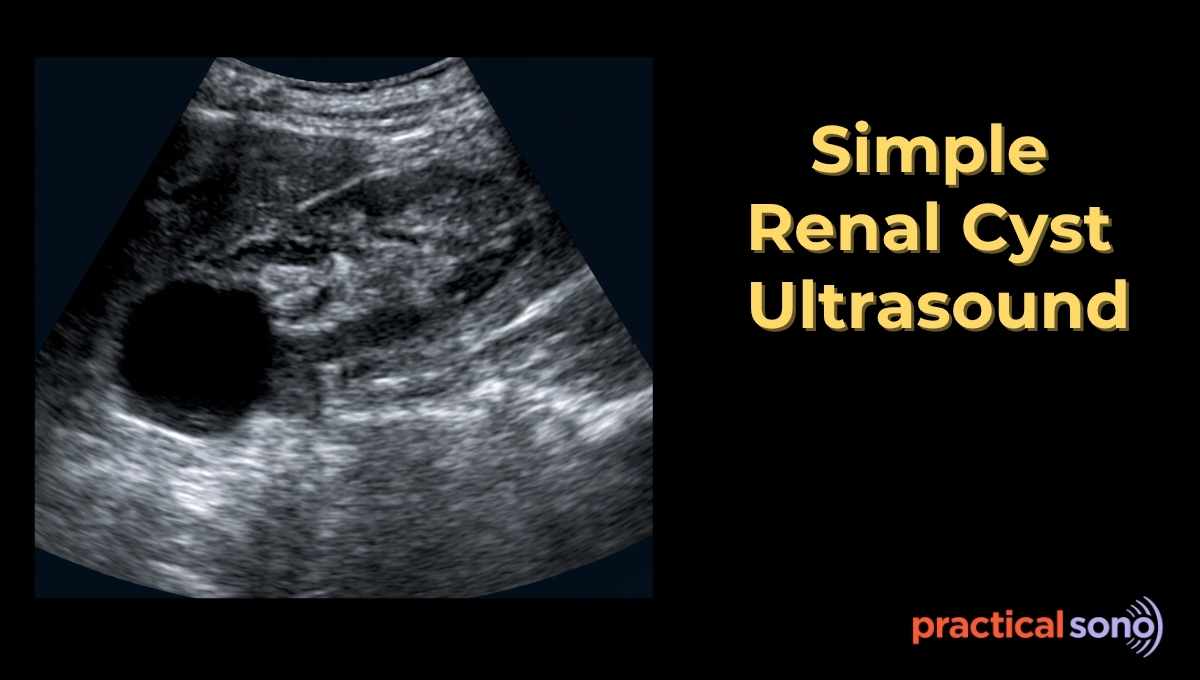 simple renal cyst