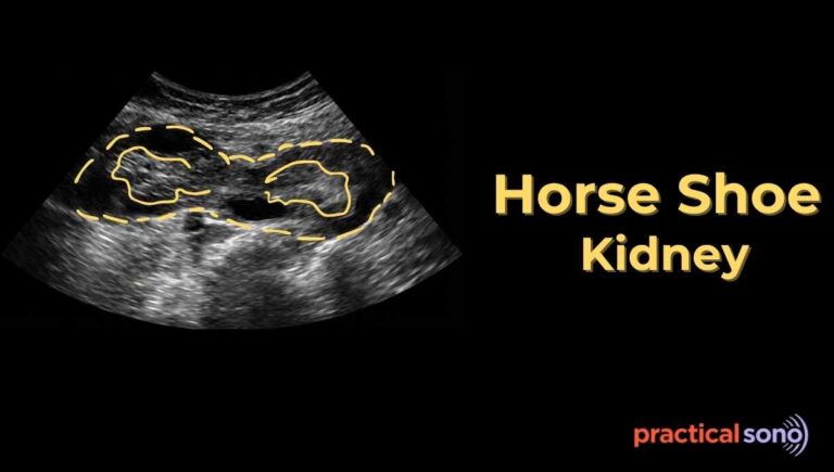 horse shoe kidney ultrasound