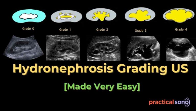 hydronephrosis grading ultrasound