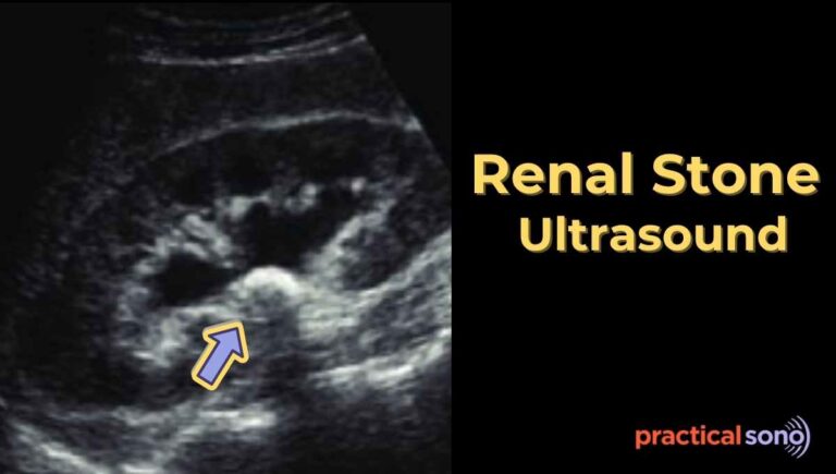 renal stone ultrasound